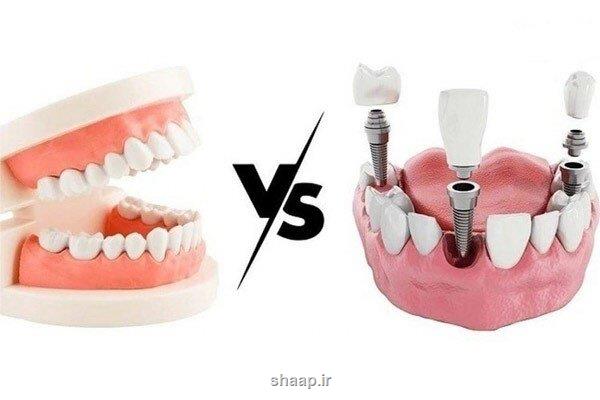 ایمپلنت دندان بهتر است یا دندان مصنوعی؟ بررسی تخصصی و مقایسه هزینه ها