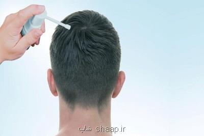 تأثیر ماینوكسیدیل پس از كاشت مو چگونه است؟